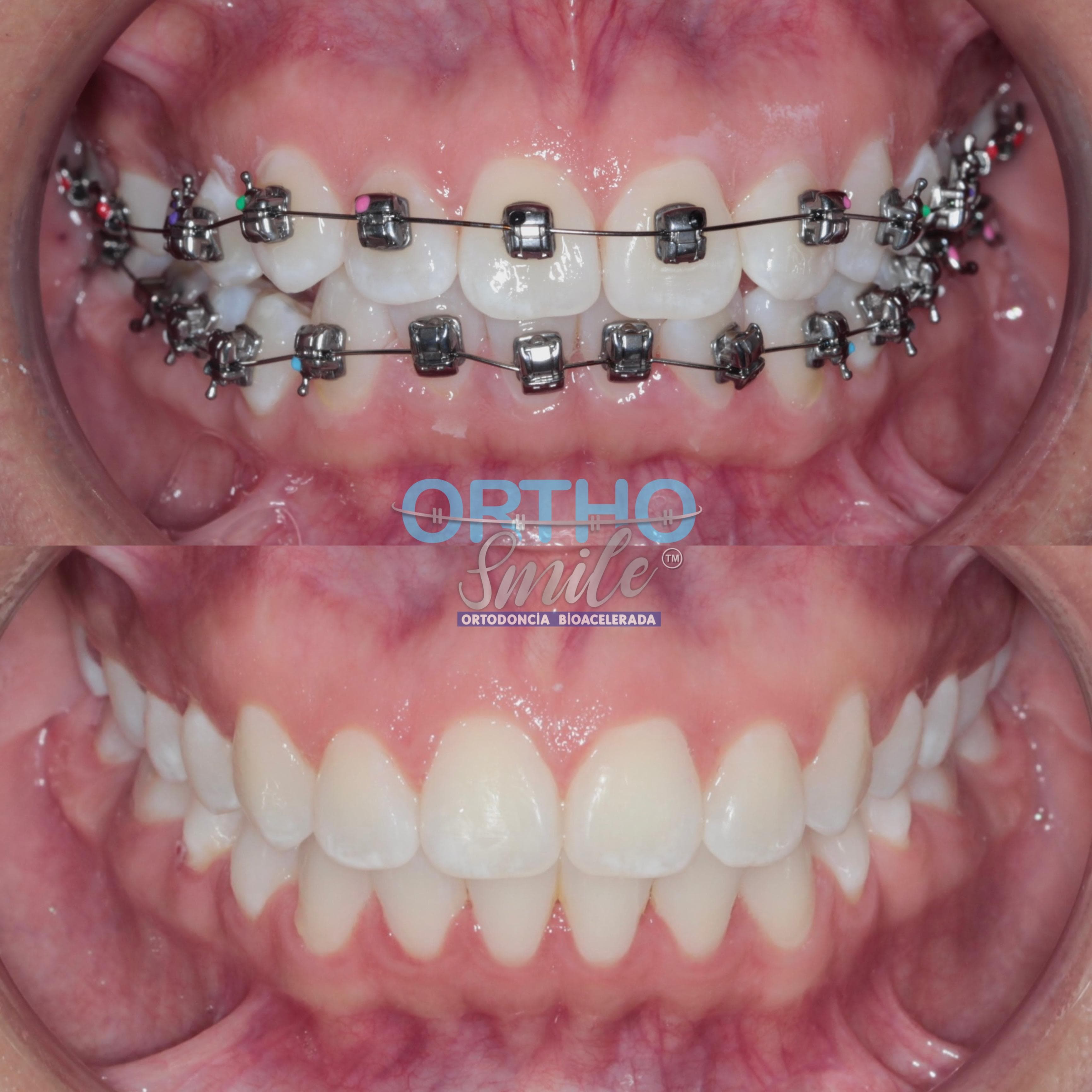 Resultado de ortodoncia OrthoSmile: antes con brackets y después con la sonrisa alineada — Caso 1